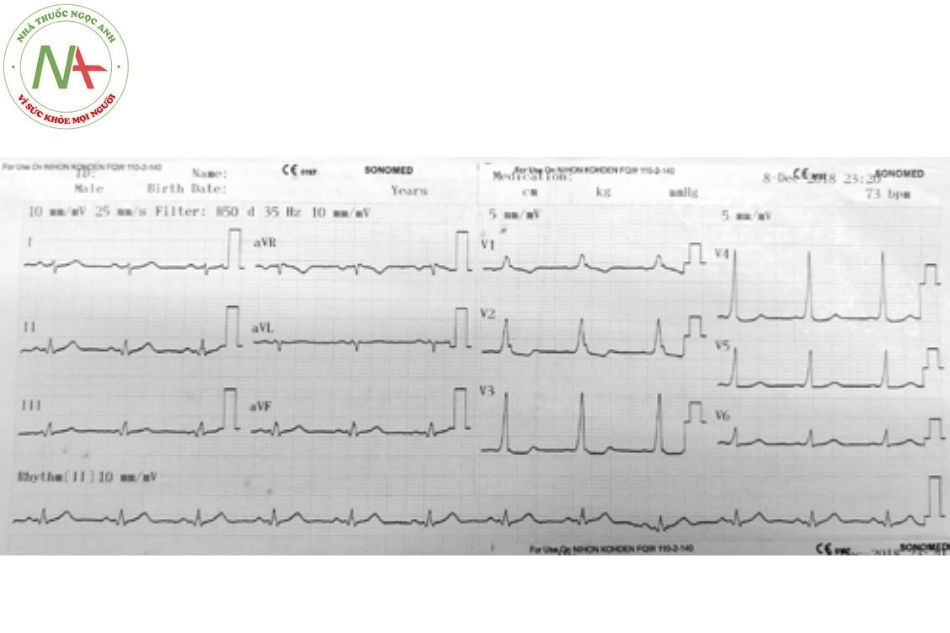 Hình 14. Hội chứng WPW type A với sóng delta dương ở V1