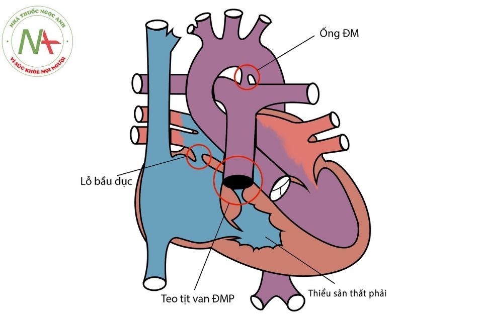 Hình 17. Tuần hoàn bào thai trong bệnh teo tịt van động mạch phổi kèm lành vách liên thất