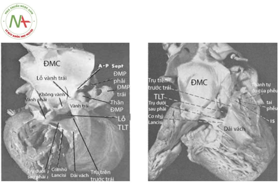 Hình 2. So sánh hình thái thân chung động mạch và tứ chứng Fallot