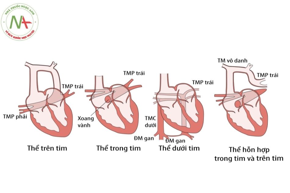 Hình 2. Bất thường đổ về tĩnh mạch phổi toàn phần