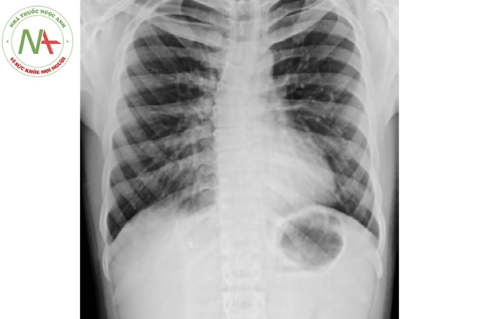 Hình 2. Xquang ngực cho thấy vẹo cột sống ở bệnh nhân hội chứng Marfan