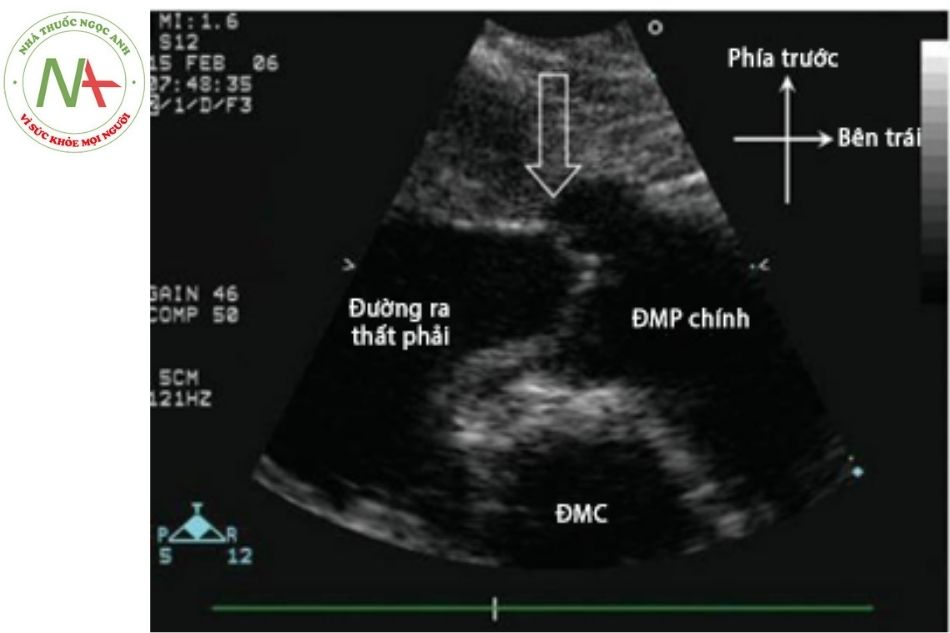 Hình 20. Hình ảnh teo tịt van động mạch phổi trên siêu âm tim trong teo tịt van động mạch phổi kèm lành vách liên thất