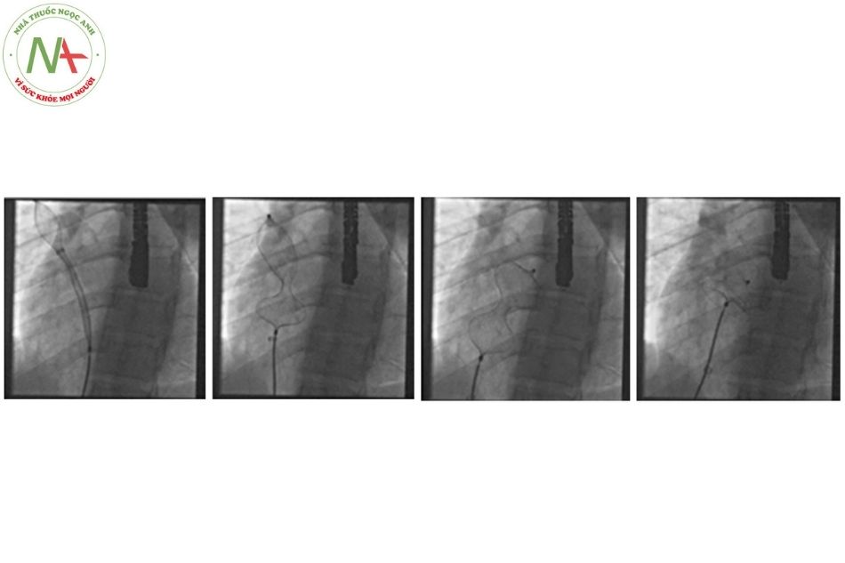 Hình 19. Thả dụng cụ bít thông liên nhĩ tiếp cận qua tĩnh mạch phổi trên phải