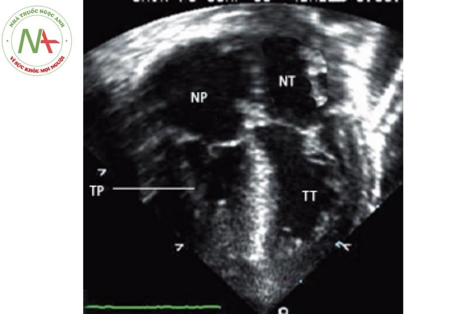 Hình 21. Hình ảnh giãn nhĩ phải và phì đại phần cơ bè trên siêu âm tim trong teo tịt van động mạch phổi kèm lành vách liên thất