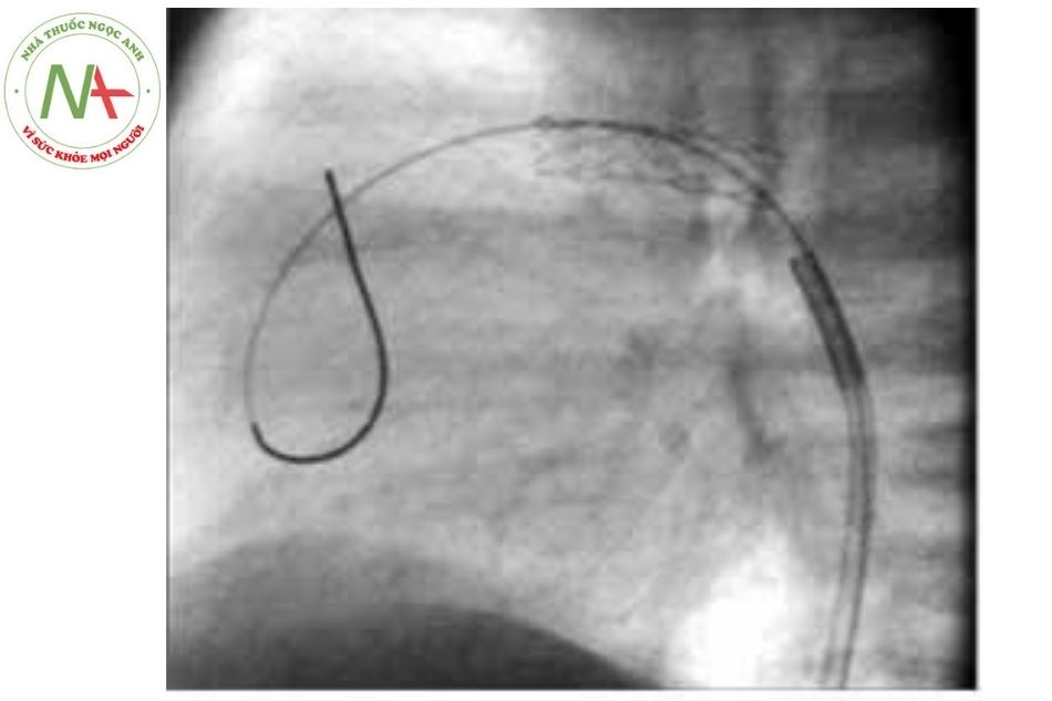 Hình 23. Hình ảnh đặt stent ống động mạch trong teo tịt van động mạch phổi kèm lành vách liên thất