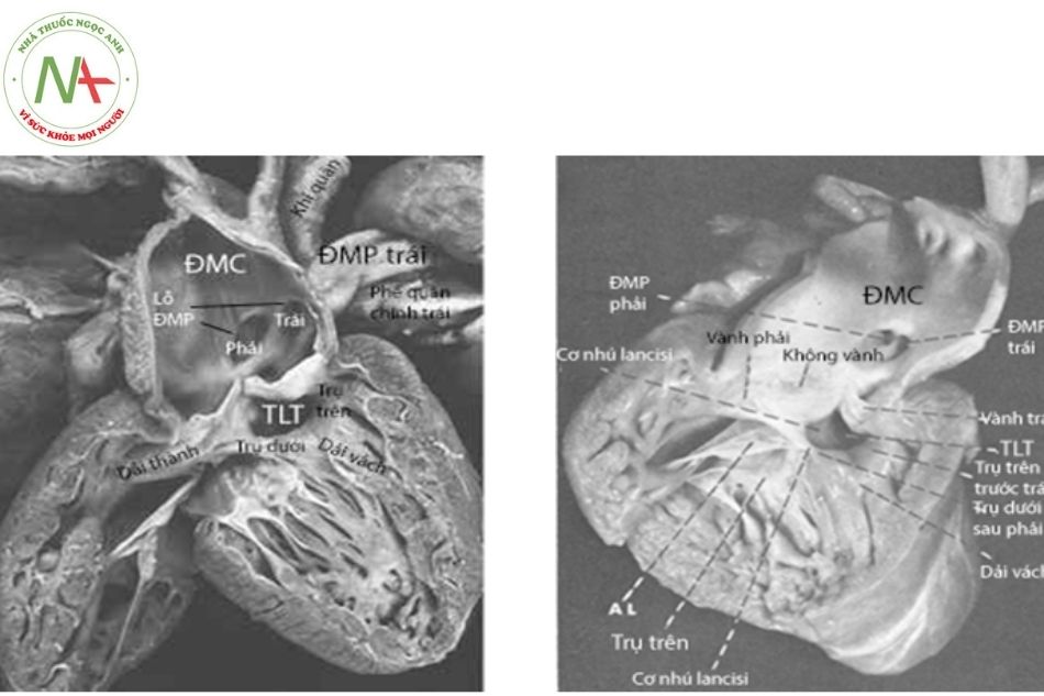 Hình 3. Giải phẫu thân chung động mạch type II của Collett (type A2 của Van Praagh) với động mạch chủ có nguồn gốc từ thân chung, hai lỗ động mạch phổi phải và trái xuất phát từ thành sau thân chung. Thông liên thất được giới hạn ở dưới bởi trụ trên và trụ dưới của dải vách . Trụ dưới hợp nhất với dải thành ngăn cách van thân chung (có hai lá van) với van ba lá. Vách phễu và cơ nhú trong của van ba lá không tồn tại.