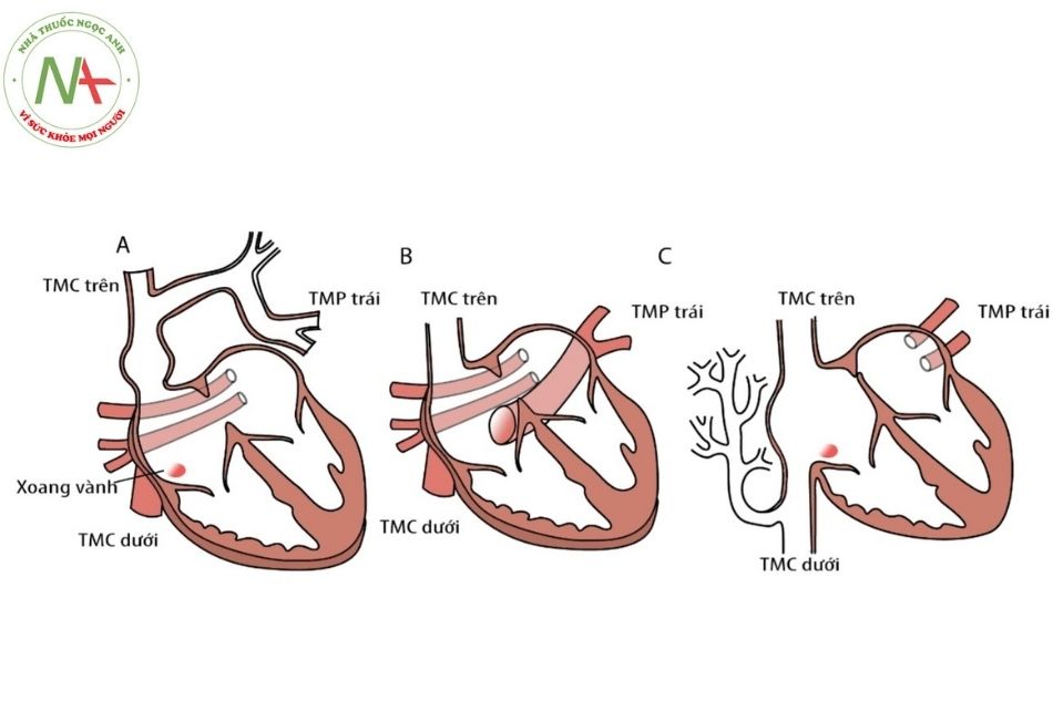 Hình 3. Bất thường đổ về tĩnh mạch phổi bán phần