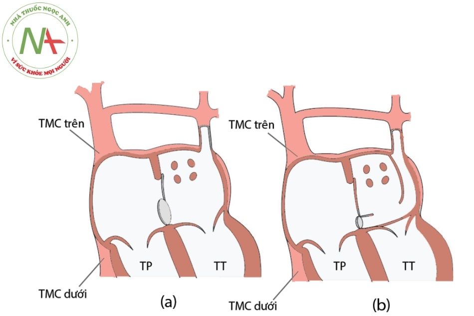 Hình 3. Thông liên nhĩ thể xoang tĩnh mạch vành (a). Tồn tại tĩnh mạch chủ trên trái đổ về nhĩ trái