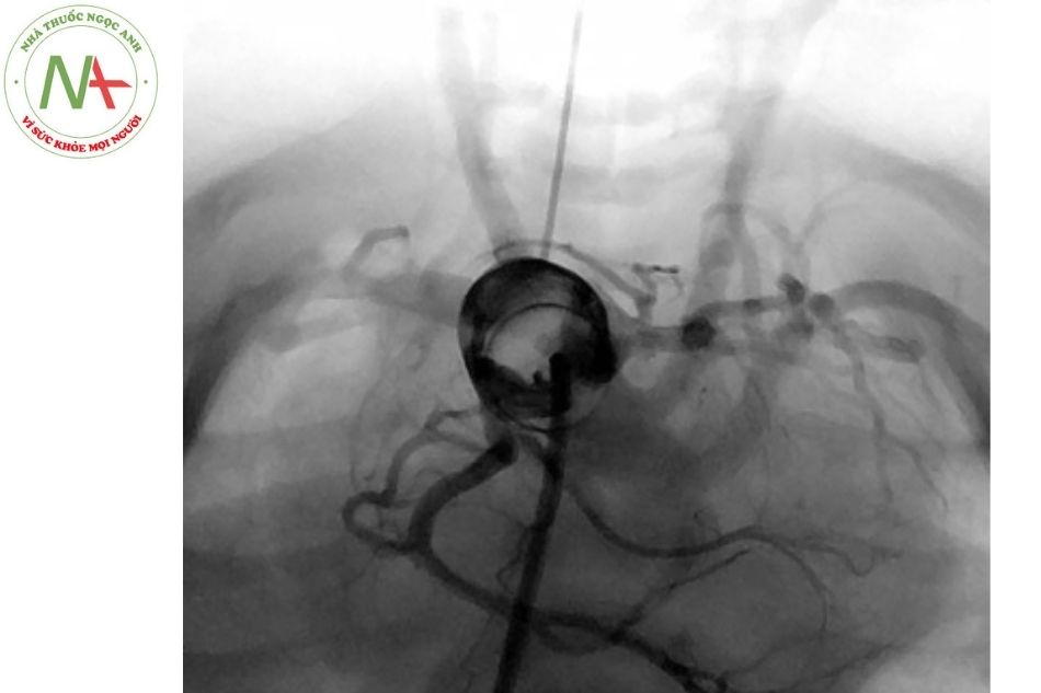 Hình 4. Tiếp cận xuôi dòng động mạch chủ, sử dụng ống thông có bóng Berman chụp mạch bít nhằm khảo sát động mạch vành ở trường hợp bệnh nhân chuyển gốc đại gốc động mạch. Hình ảnh chụp mạch cho thấy động mạch mũ xuất phát từ động mạch vành phải ở bệnh nhi 2 ngày tuổi.