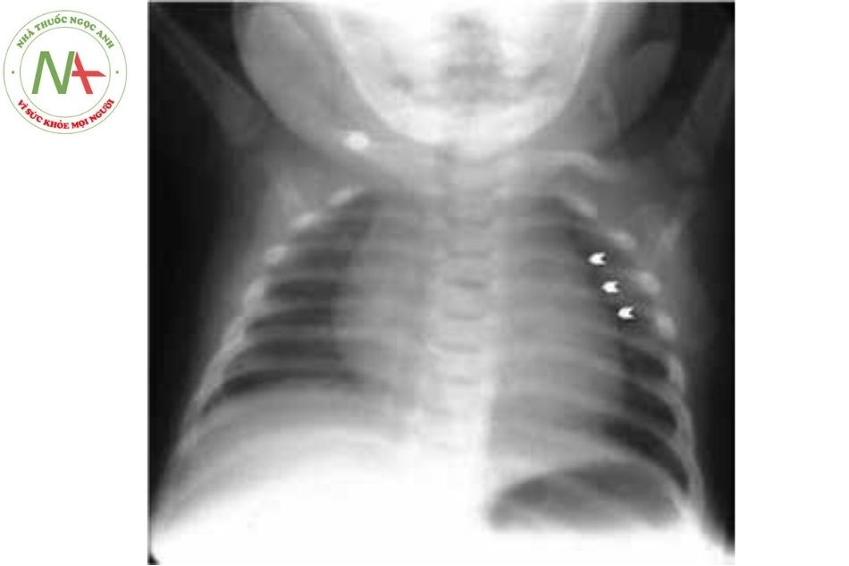 Hình 3. Phim Xquang ngực thẳng của trẻ sơ sinh với tuyến ức có dấu hiệu lượn sóng (wave-sign) do xương sườn tì vào, hay gặp ở bên trái