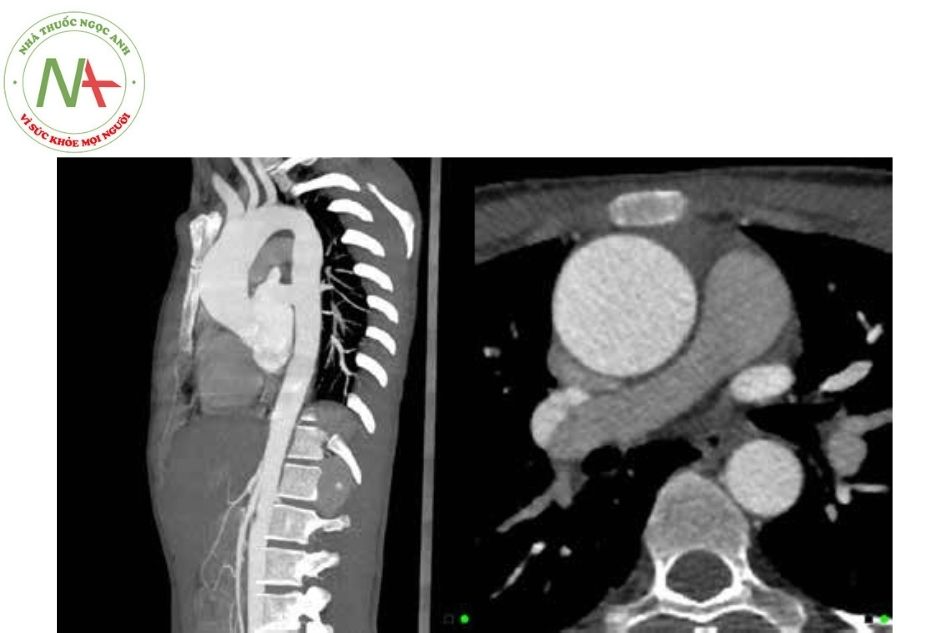 Hình 4. Giãn động mạch chủ lên ở bệnh nhân hội chứng Marfan