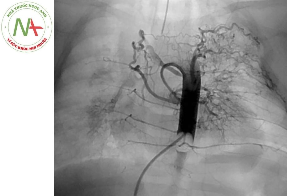 Hình 5. Hình ảnh chụp tuần hoàn bàng hệ ở bệnh nhân 6 tháng tuổi mắc thất trái hai đường vào sau phẫu thuật siết bớt động mạch phổi (pulmonary artery banding); sử dụng ống thông Berman, góc chụp thẳng mặt.