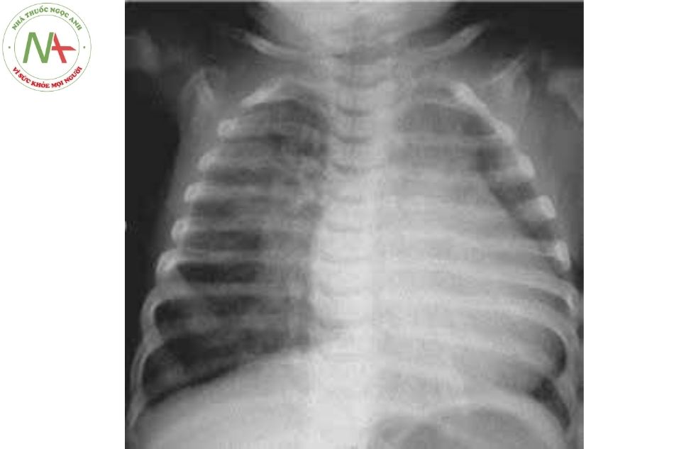 Hình 4. Phim Xquang ngực thẳng cho thấy bóng tim to kèm phì đại cả hai thất, cung động mạch phổi giãn và tăng đậm mạch máu phổi