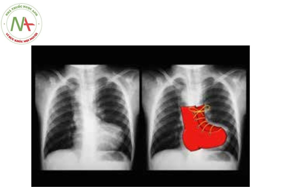 Hình 4A. Hình ảnh phim Xquang ngực bệnh nhân có tứ chứng Fallot thấy bóng tim hình chiếc ủng