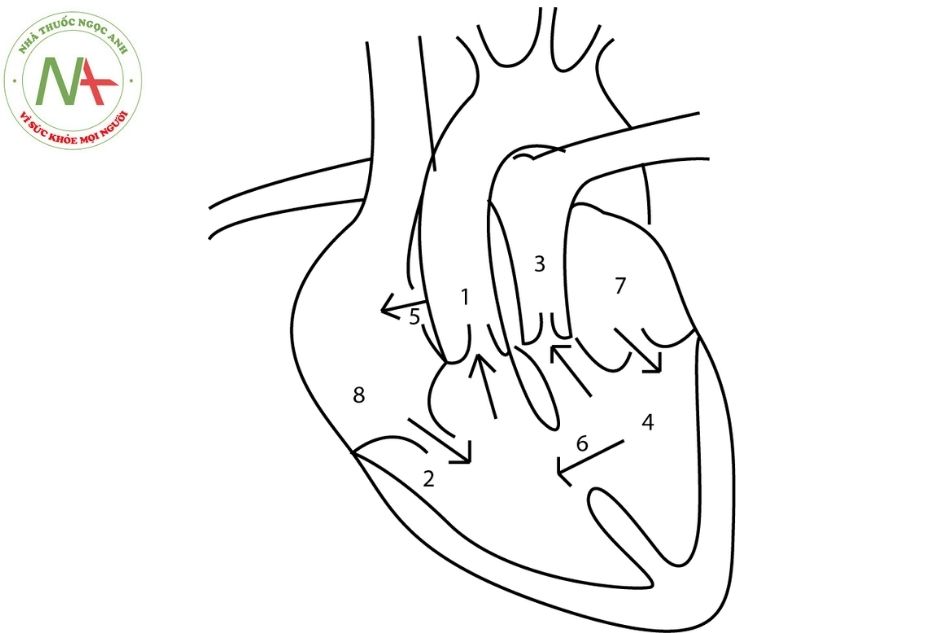 Hình 4B. Hình ảnh chụp Xquang ngực bệnh nhân có chuyển gốc đại động mạch thấy bóng tim hình trứng. Hình vẽ mô tả dòng chảy của máu (mũi tên) trong tim có chuyển gốc đại động mạch.