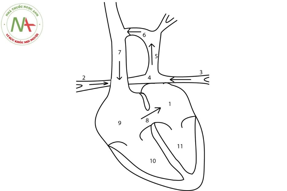 Hình 4C. Dấu hiệu người tuyết trên phim chụp Xquang ngực bệnh nhân có bất thường đổ về tĩnh mạch phổi toàn phần (thể trên tim).