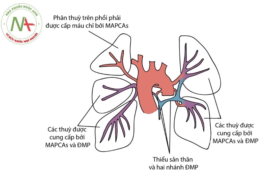 Hình 5. Sơ đồ minh họa các kiểu cấp máu cho phổi ở PA-VSD