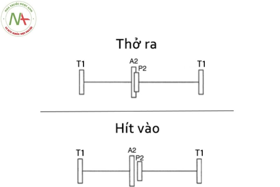 Hình 5. Độ mạnh của thành phần A2 và P2 trong tiếng T2 và sự tách đôi của tiếng T2 theo chu kỳ hô hấp A2: tiếng đóng của van động mạch chủ.