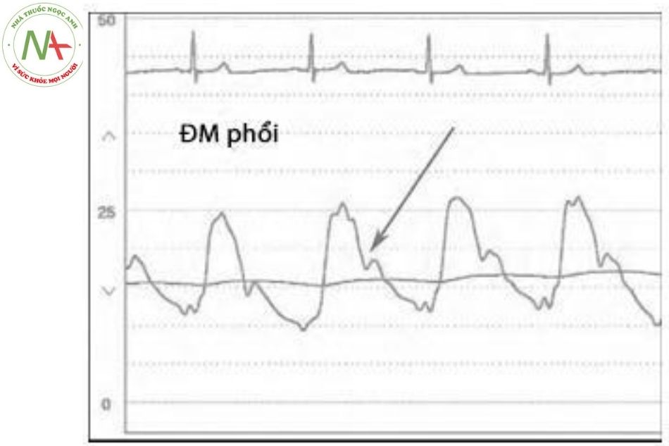 Hình 14. Hình ảnh sóng áp lực bình thường của động mạch phổi, mũi tên chỉ sóng dội ngược dạng nóc