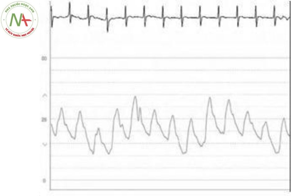Hình 15. Hình ảnh sóng áp lực động mạch phổi thay đổi theo chu kỳ hô hấp