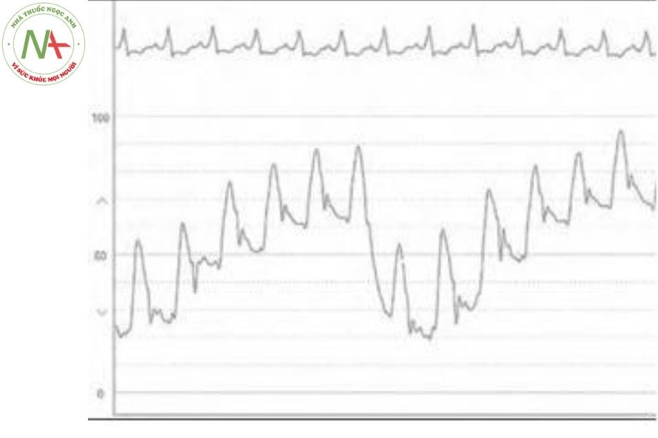 Hình 16. Hình ảnh sóng áp lực động mạch phổi theo chu kỳ hô hấp ở bệnh nhân tăng áp động mạch phổi