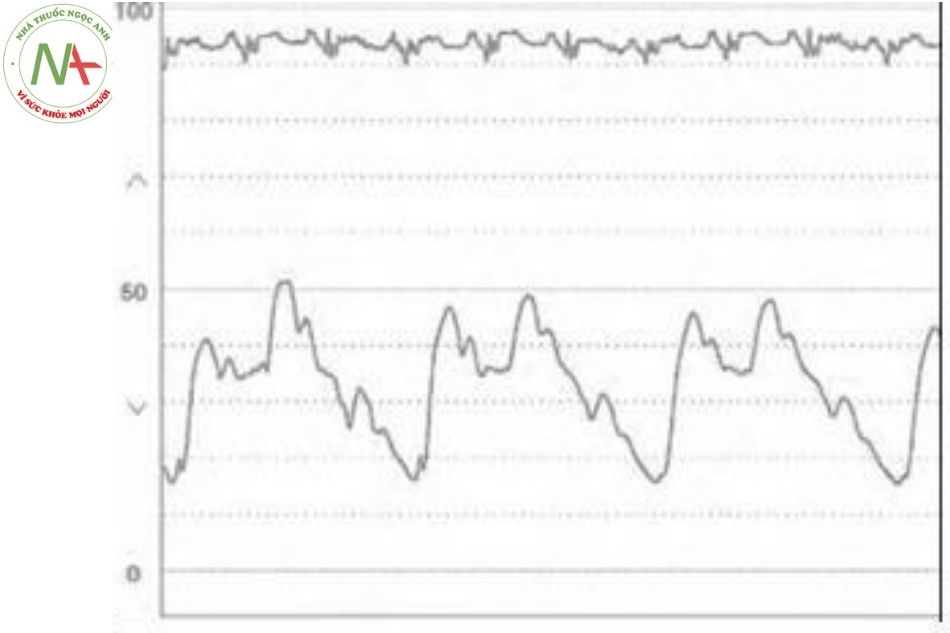 Hình 17. Hình ảnh sóng áp lực động mạch phổi theo chu kỳ hô hấp ở bệnh nhân béo phì