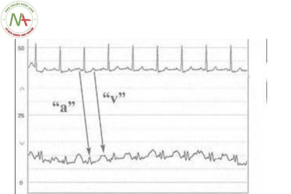 Hình 18. Hình ảnh sóng áp lực mao mạch phổi bít (PCWP) với sóng a và v rõ