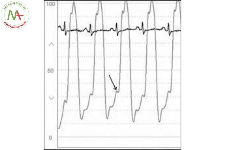 Hình 21. Hình ảnh sóng (mũi tên) áp lực cuối tâm trương thất trái ở bệnh nhân suy tim