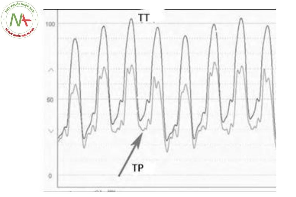 Hình 24. Hình ảnh sóng áp lực khi đo đồng thời tâm thất phải và trái ở bệnh nhân suy tim và tăng áp phổi, áp lực tâm thu tăng và giảm cùng nhau trong chu chuyển hô hấp, áp lực tâm trương thất trái cao hơn thất phải khoảng 5 mmHg