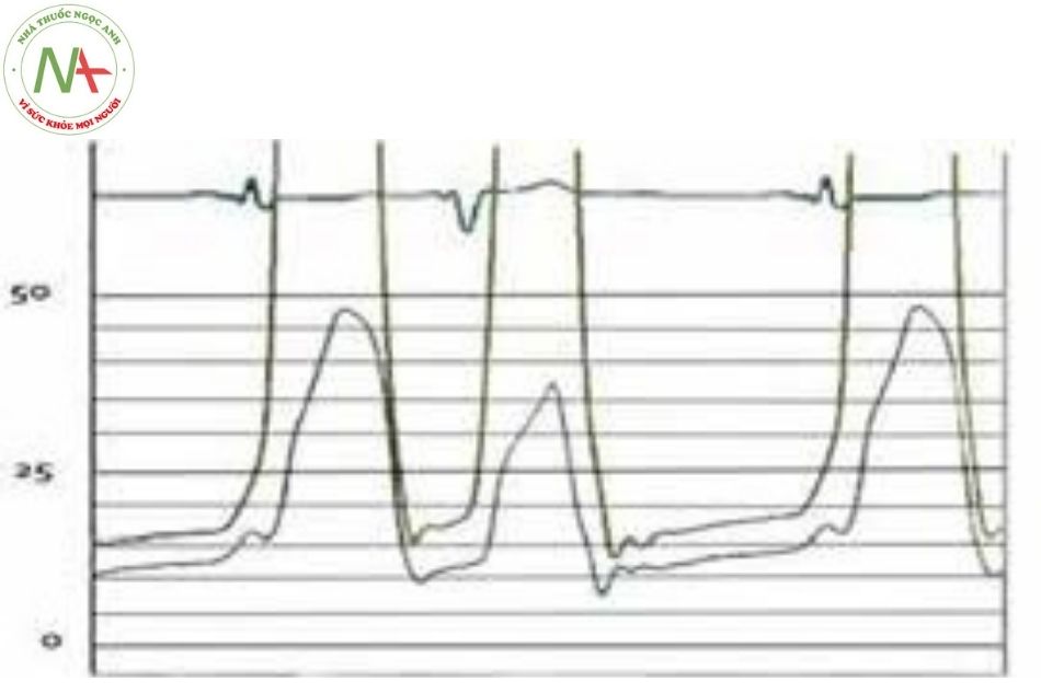 Hình 26. Hình ảnh sóng áp lực đo đồng thời tâm thất phải và tâm thất trái ở bệnh nhân block nhánh phải (sóng thất phải dịch chuyển về bên phải)