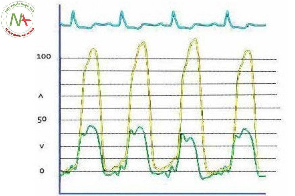 Hình 27. Hình ảnh sóng áp lực đo đồng thời tâm thất phải và tâm thất trái ở bệnh nhân block nhánh trái (sóng thất phải dịch chuyển về bên trái)