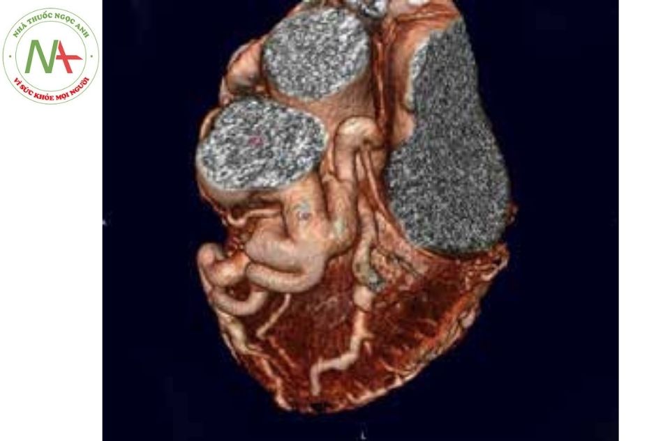 Bất thường động mạch vành xuất phát từ ĐMP (ALCAPA) trên ảnh chụp CLVT 3D ở bệnh nhân 66 tuổi.