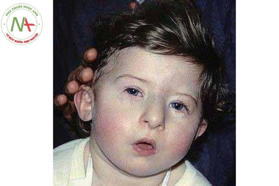 Hình 6. Trẻ mắc hội chứng DiGeorge với bộ mặt bất thường (cằm không phát triển, tai thấp và xoay ra sau, khoảng cách hai mắt xa nhau, mắt lồi, chóp mũi hình củ hành)