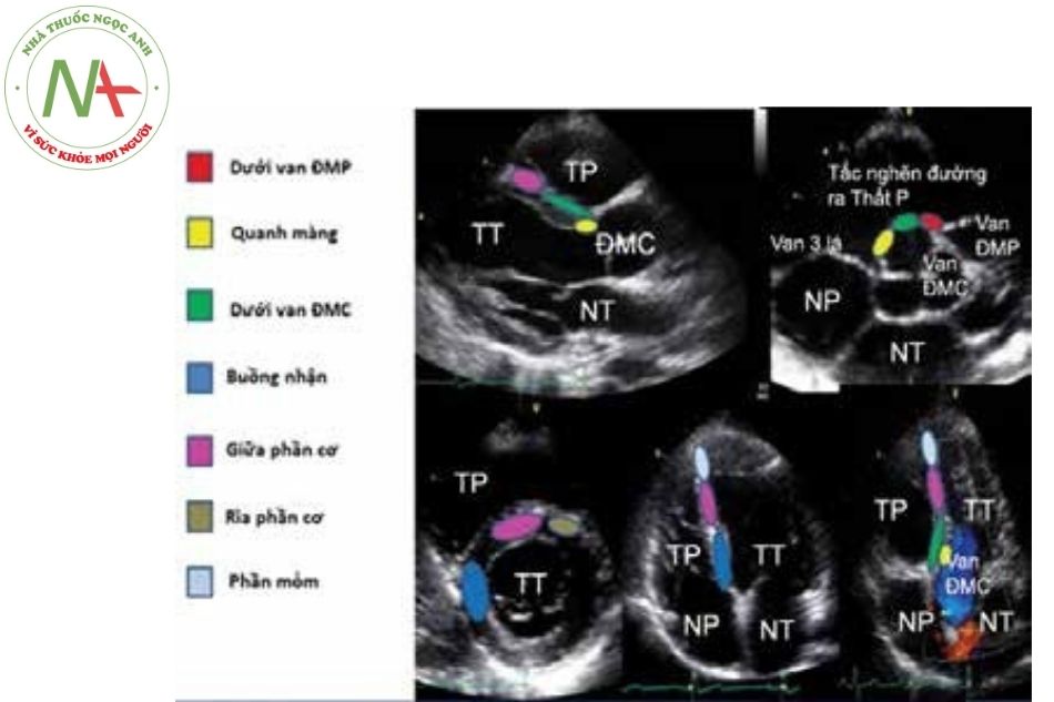 Hình 15.6. Minh họa các vị trí TLT trên siêu âm tim