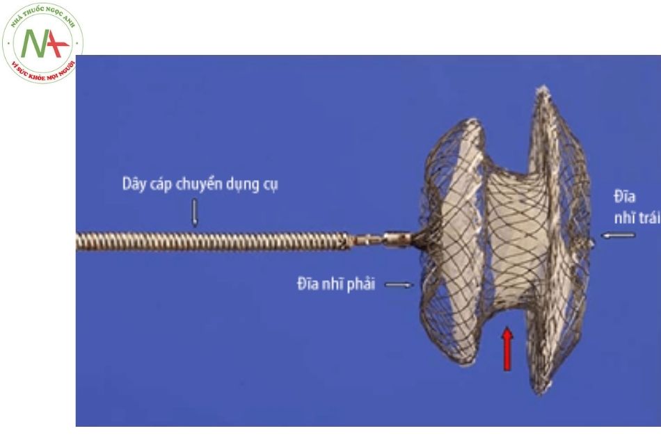 Hình 6. Dụng cụ bít thông liên nhĩ của Amplatzer (ASO)