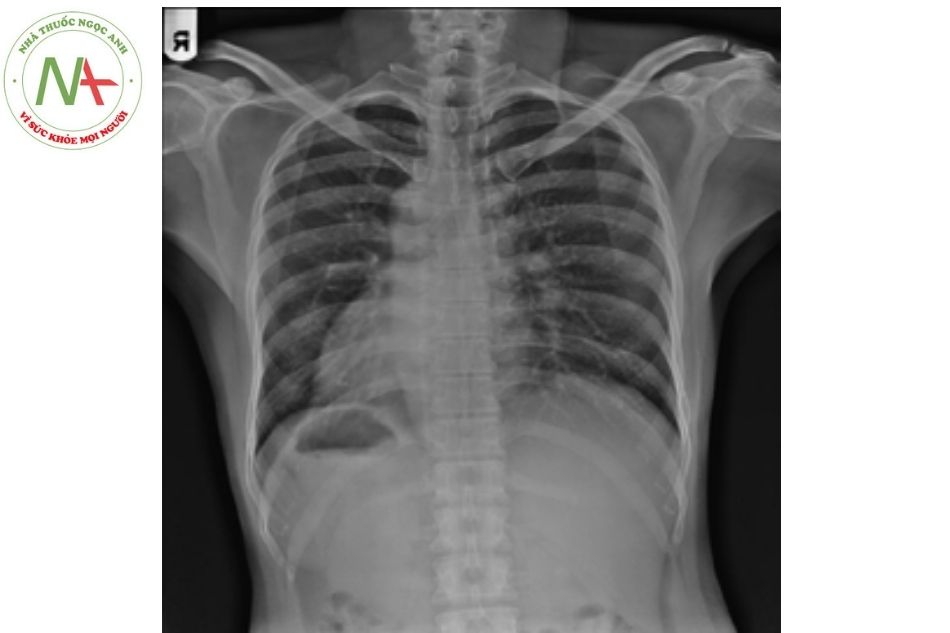 Hình 6. Hình ảnh Xquang ngực của bệnh nhân có đảo ngược phủ tạng ngực và bụng (thể situs inversus dextrocardia)