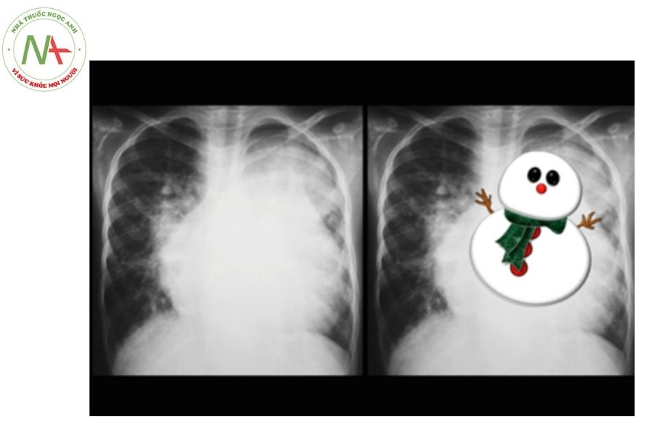 Hình 7. Hình ảnh chụp Xquang ngực ở bệnh nhân có bất thường đổ về tĩnh mạch phổi toàn phần, với hình ảnh “người tuyết”