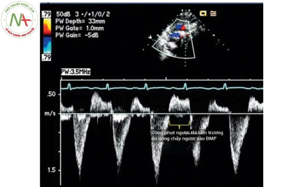 Hình 7. PW Doppler ở phần trên của động mạch chủ xuống cho thấy dòng phụt ngược liên tục thì tâm trương vì dòng máu chạy ngược vào động mạch phổi Chú thích: ĐMP: Động mạch phổi.