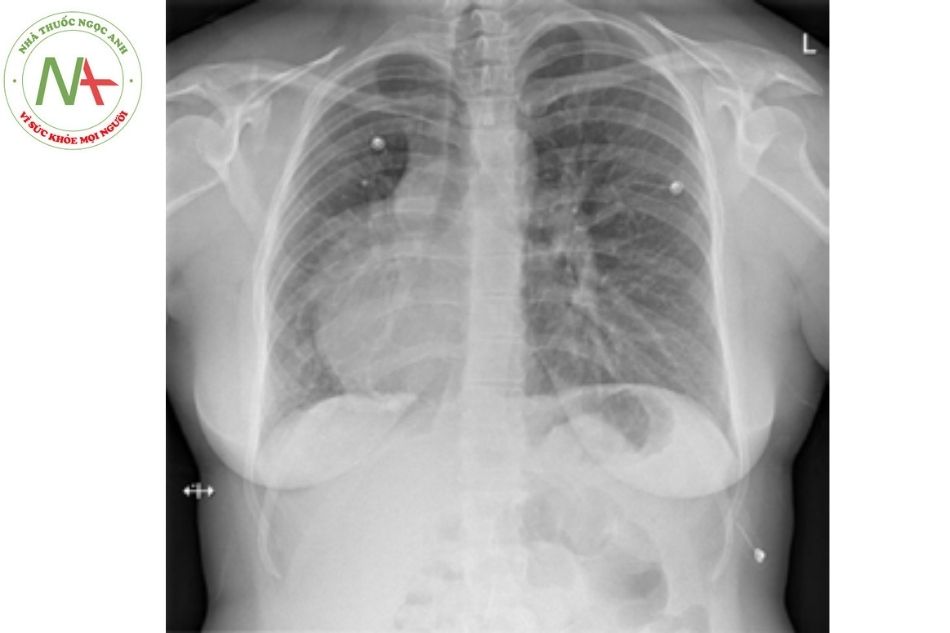Hình 7. Hình ảnh Xquang ngực của bệnh nhân có tim quay phải nhưng các tạng khác có vị trí bình thường (thể situs solitus dextrocardia)