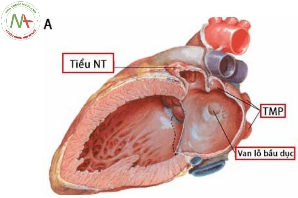 Hình Giải phẫu tâm nhĩ trái Cắt dọc tim, nhìn từ bên trái (Nguồn: Frank Netter);