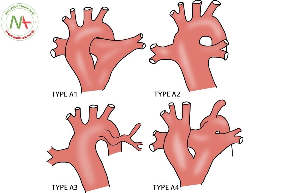 Hình 8. Thân chung động mạch type A1 với thân động mạch phổi tách ra từ mặt sau thân chung ở mặt cắt trên hõm ức