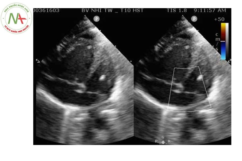 Hình 8. Thất phải giãn to, thất trái bé, vách liên thất võng sang trái trên mặt cắt 4 buồng từ mỏm ở bệnh nhân bất thường đổ về tĩnh mạch phổi toàn phần thể trên tim