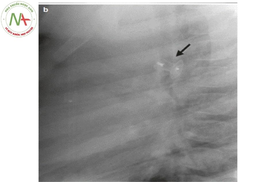 Hình 17.8. Hình ảnh dụng cụ bít ống động mạch sau can thiệp trên phim chụp tim phổi nghiêng