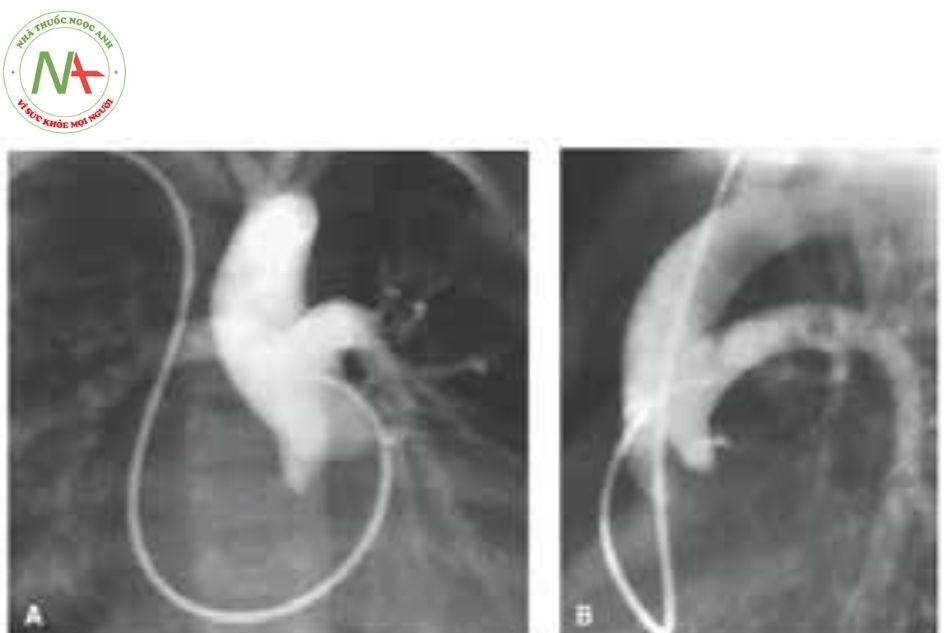 Hình 9. Chụp động mạch chủ (A: trước sau, B: nghiêng) thấy động mạch phổi xuất phát từ động mạch chủ trong thân chung động mạch