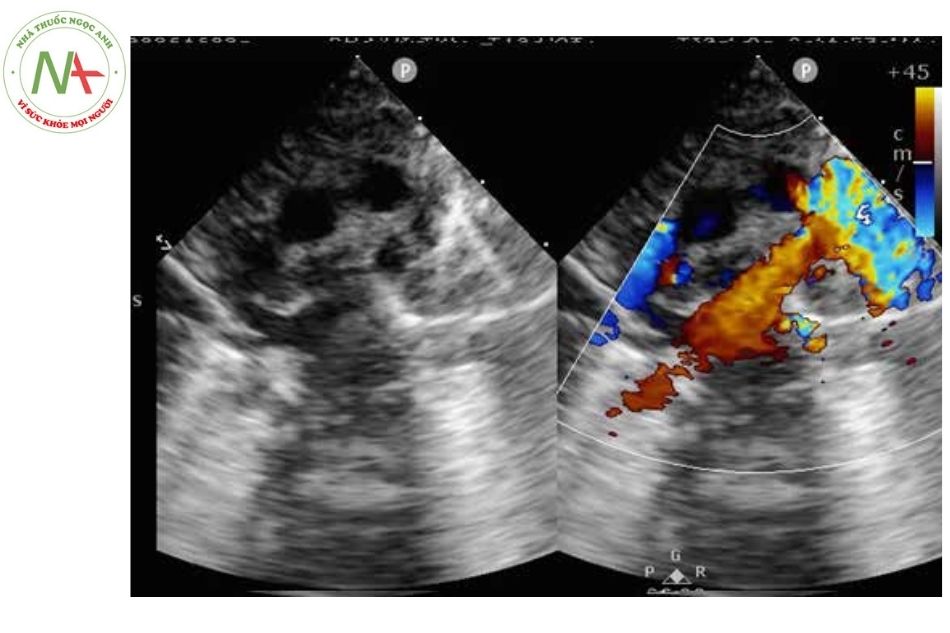 Hình 9. Bốn tĩnh mạch đổ về hợp lưu sau đó đổ về tĩnh mạch chủ trên trái trong bất thường đổ về tĩnh mạch phổi hoàn toàn thể trên tim