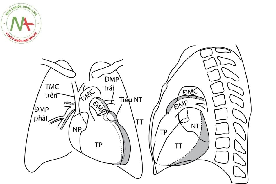 Hình 8. Minh họa hình ảnh giãn/phì đại các buồng tim trái trên phim Xquang ngực