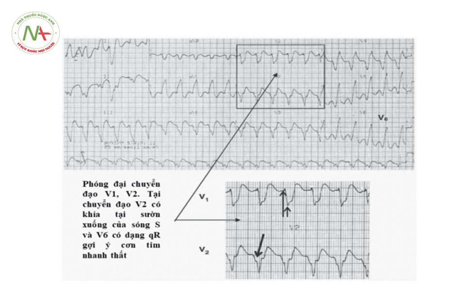 Hình 40. Cơn tim nhanh QRS giãn rộng dạng block nhánh trái. Tại chuyển đạo V2 có khía tại sườn xuống của sóng S và V6 có dạng qR gợi ý cơn tim nhanh thất.