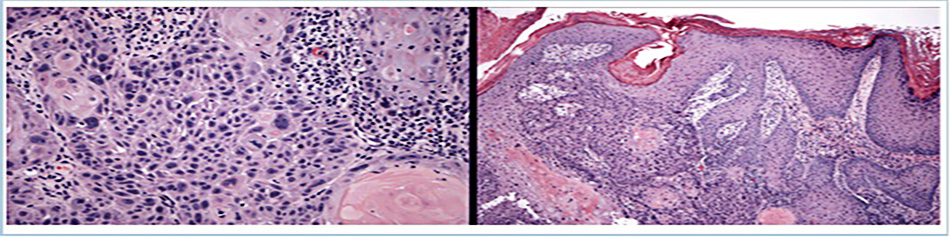 Mẫu sinh thiết minh của SCC xâm lấn với tế bào sừng bất thường xâm lấn, ảnh hưởng đến tất cả các lớp biểu bì và thâm nhiễm sâu hơn vào lớp trung bì. Độ phóng đại cao hơn (bên trái) làm nổi bật cấu trúc tế bào bất thường Trích từ tư liệu riêng của Tiến sĩ Nwaneshiudu và Tiến sĩ Soltani