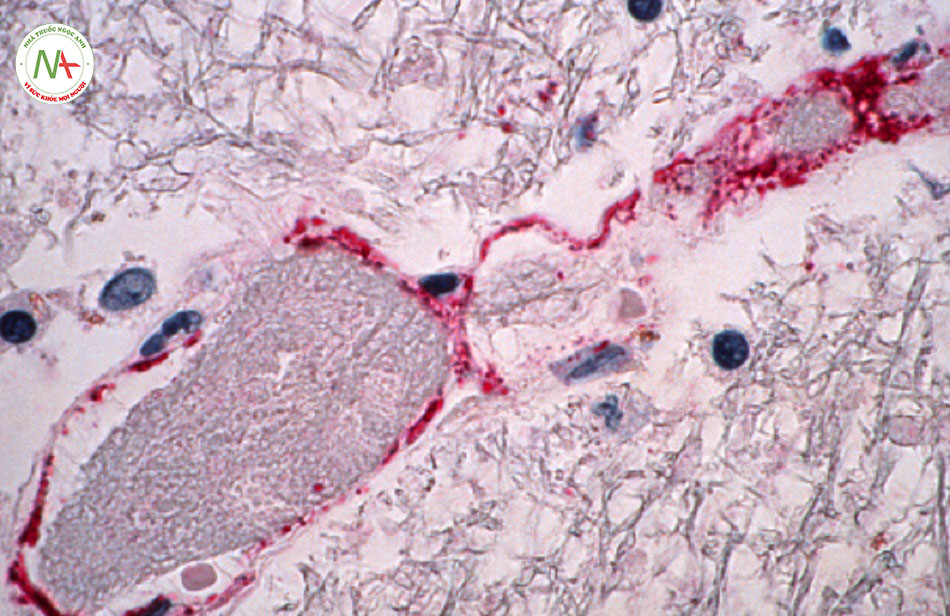 Hình 1: Ảnh chụp hiển vi cho thấy sự hình thành của cục nghẽn và tổn thương thoái hóa lớp nội mô do nhiễm trùng NiV gây ra