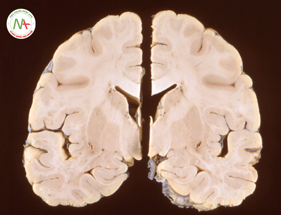 Hình 2: Ảnh chụp hiển vi cho thấy một số thay đổi bệnh học liên quan tới nhiễm NiV ảnh hưởng tới hệ thần kinh trung ương